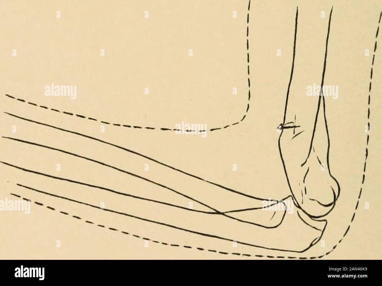 The treatment of fractures . Fig. 230.—Supracondyloid fracture. Obliquity of the line of