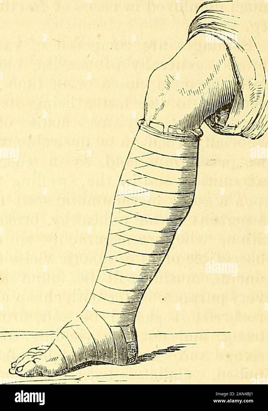 A system of surgery : pathological, diagnostic, therapeutic, and operative . Mode of applying the roller by circular audreversed turns. Appearauce of tlic bandage after it has beeaapplied. The evil eifects of unequal compression by the bandage are well illustrated infig. 158, copied from John Bell; it also shows how important it is always tobegin the application of the bandage at the distal extremity of a limb, and notabove the wrist or ankle, as happened in the case so graphically described by thecelebrated Scotch surgeon. In all cases of severe injury or disease, with a tend-ency to swelling Stock Photo