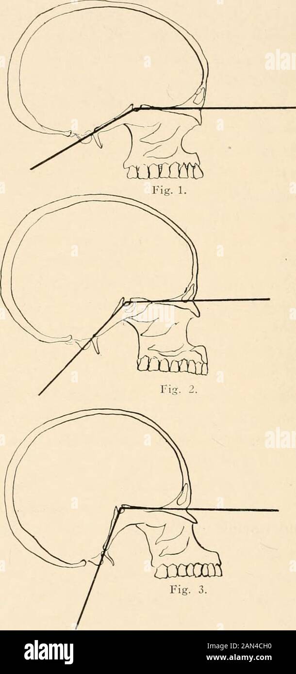 Roentgen diagnosis of diseases of the head . ating line from the root of the nose to the mostanterior edge of the foramen magnum (length of skull base,100 mm.). In addition one obtains several are measurements,the most important of which are the greatest horizontal circum-ference (520 mm.) and the arc of the vault between the ex-ternal auditory meati (315 mm.). According to the suggestion of Eetzius, one usually deter-mines the arithmetrical relation between the linear diameters, inorder, in this way, to learn a uniform numerical expression forthe fundamental shape of the skull. Most often the Stock Photo