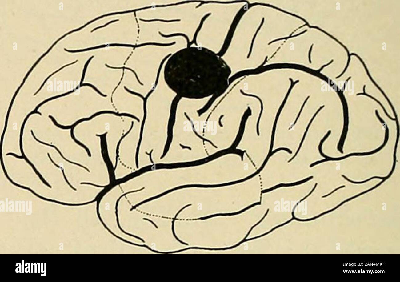 Organic and functional nervous diseases; a text-book of neurology . Situation of tumor causing cortical spasmand motor aphasia. Head and eyes turned tothe right, then forehead and cheek were drawnto the right. Situation of cyst causing spasm of rightshoulder, extending down the arm and to thefingers. Cyst removed. between both in the spasm. Occasionally large movements at thejoints are made, and the hand makes wide excursions, as in one caseof mine, following a cortical hemorrhage, where the arm was flungabout like a flail. It is important to notice the order of extension ofthe spasm in the ar Stock Photo