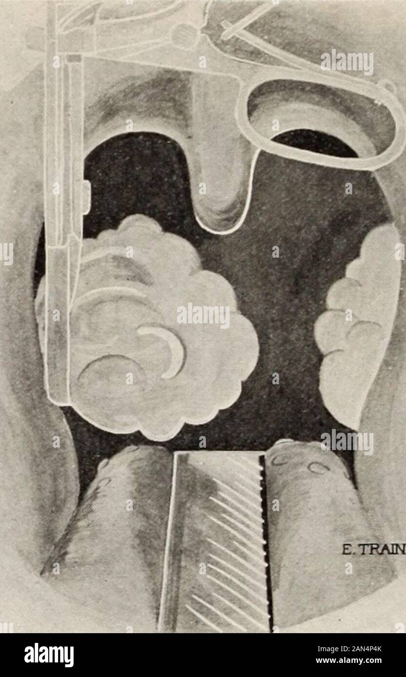 Journal of ophthalmology, otology and laryngology . onditions, certain cardio-vascular degeneration, various forms ofneuritis and kidney diseases most frequently owe their origin to somechronic latent foci of infection, there are other diseases of obscureorigin in which the same etiology is suspected. 4. This operation is uninfluenced by the age of the patient orsize or condition of the tonsil. Figure 3.—The tonsil completely engaged and the hemostat of the instru-ment pressing tightly on the blood vessels. 5. The patients throat should be well illuminated, to enable thesurgeon to place the di Stock Photo