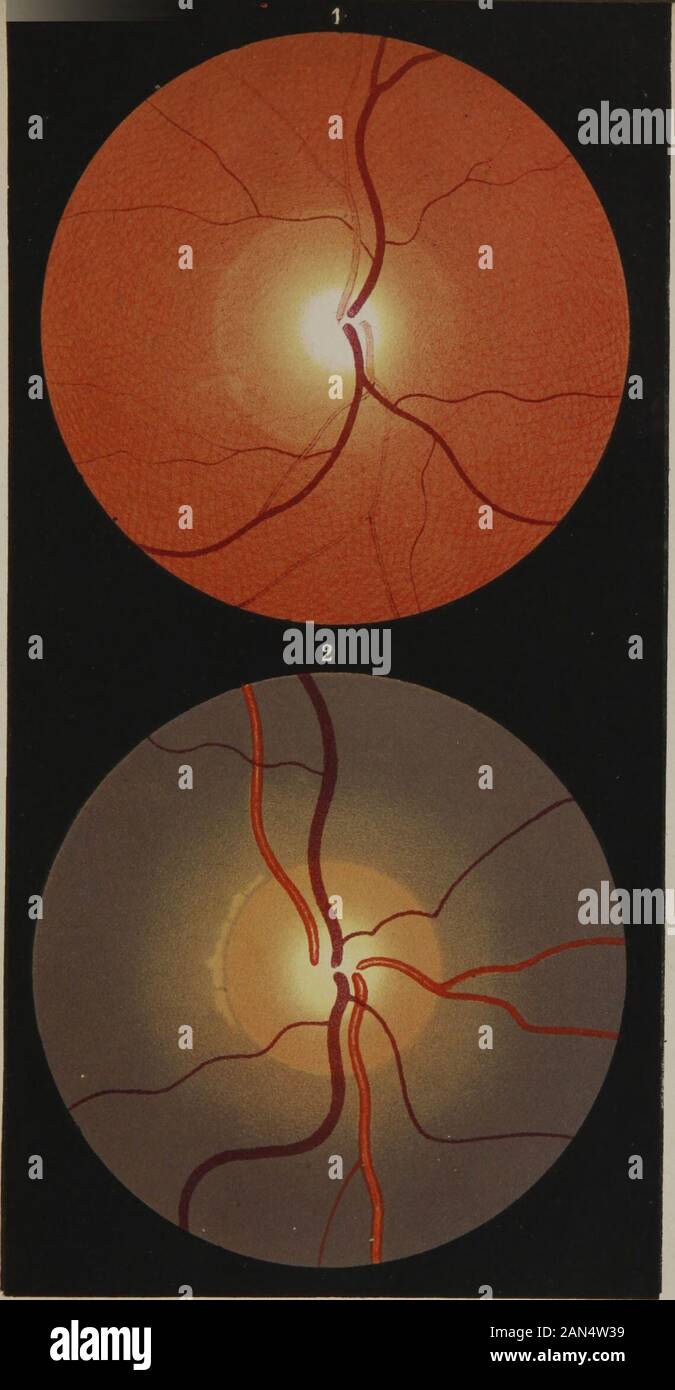 The human eye in health and disease as seen with the ophthalmoscope