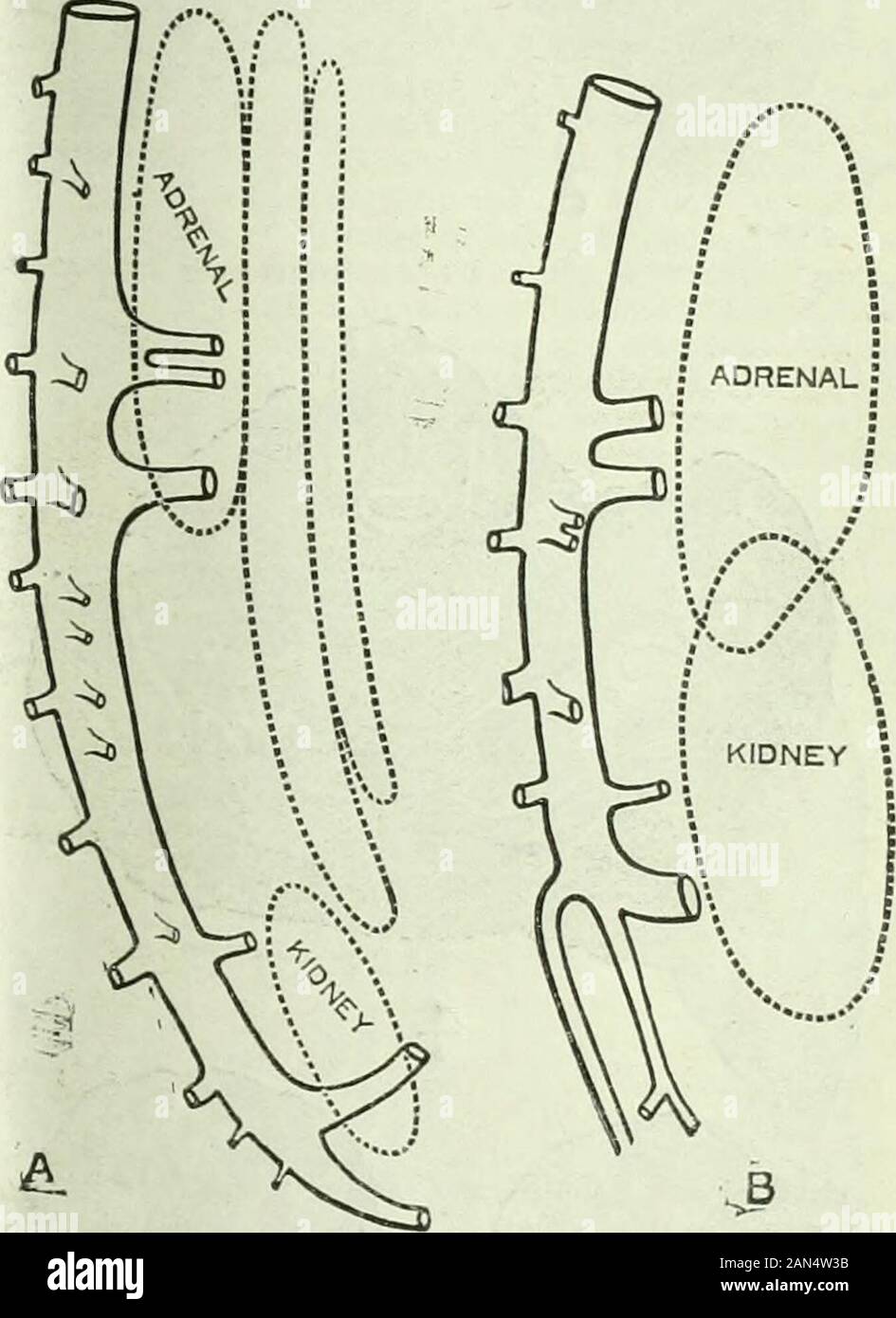 British medical journal . , I found one of hiskidneys in the hollow of the sacrum (Fig. 5); it receivedits blood supply from the right and the left common iliaoarteries. 1 have seen a kidney in this situation in a^^?oman; it ^Yas regarded before operation as a distendedFallopian tube. ^Vhen the pelvic organs were exposediu the course of the operation a curious set of anomaliesappeared. The uterus was of the unicorn variety and hada right ovary, tube, and broad ligament. The left sidewas smooth and round, and lacked appeuda.gcs of everykind, including the round ligament. The right kidneViwas no Stock Photo