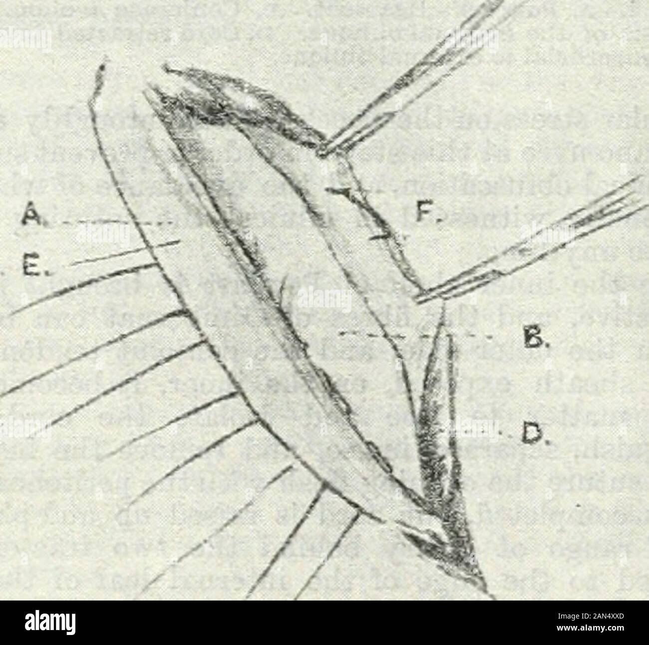 British medical journal . Via. 2.Insertion of first stiteli through Ciimheriiafs ligauieubaud coujoiued teuflon. A. Pouparts ligameut. n. Conjoined tendon.r&gt;, Covtl retracted inwar&lt;ls. E, Esterual oblique. lieruia needle further inwards through the adjoiningsheath of the rectus, so as to afford a good purchasefor the loop of the mattress suture. Finally, the two aponeurotic leaves arc united by acontinuous catgut suture, and in doing this I make it aXule to insert the point of the needle deep enough to catclihold of underljing muscle in order that no intermusculardead space may be left. Stock Photo