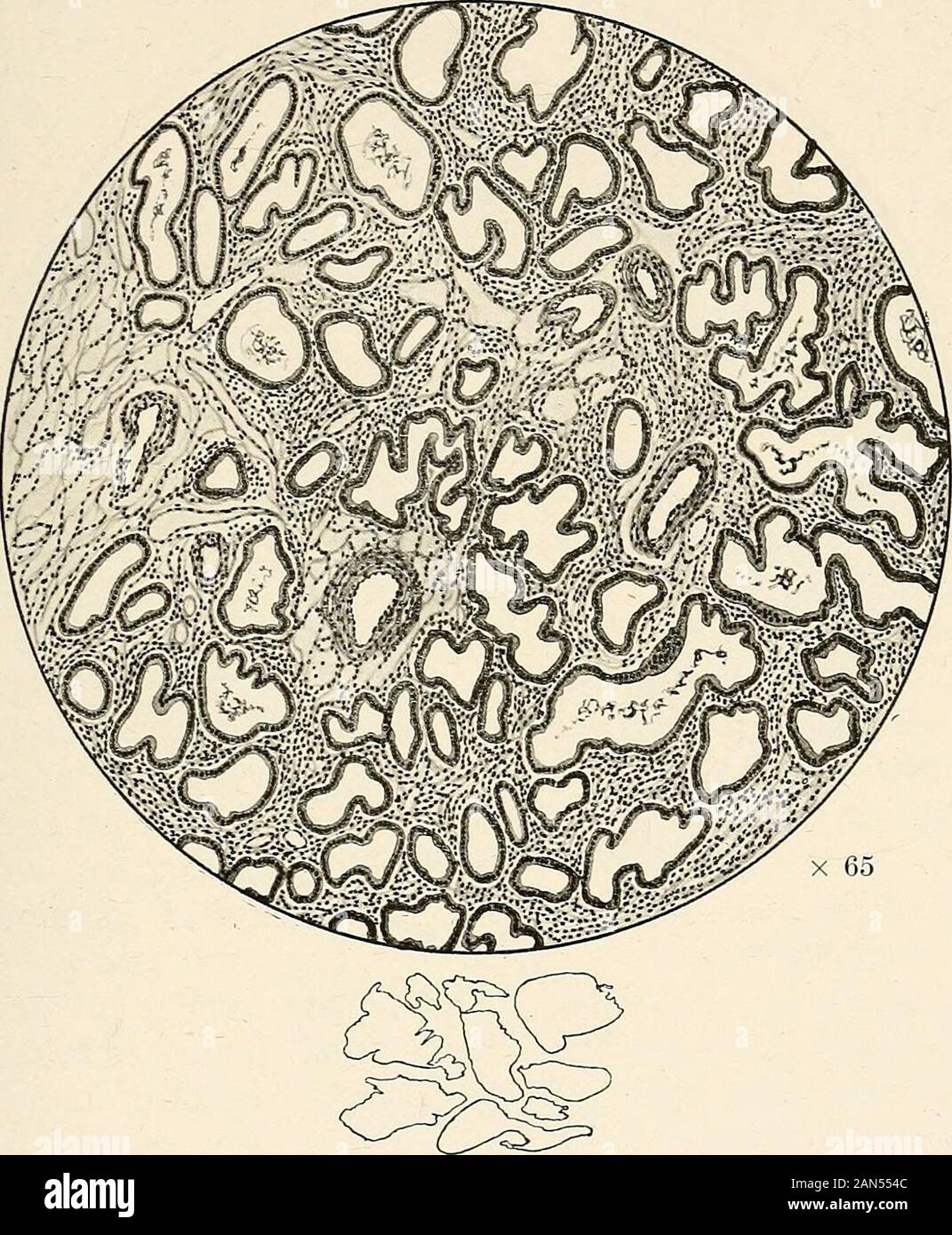 Gynaecology for students and practitioners . be distinguished :(1) diffuse-fungous ; (2) polypoidal-cystic. (1) Diffuse-fungous Form. In this form of endometritis themucous membrane is uniformly thickened and tends to the formationof polypoidal masses. Histologically it combines hypertrophy ofgland-tissue with extreme hyperplasia of the stroma {see Fig. 190).The glands are as large as those seen in the premenstrual stage, whilstthe stroma is as dense as it is in chronic interstitial endometritis. Itis probably a true inflammatory condition, and the following featureslend support to this view. Stock Photo