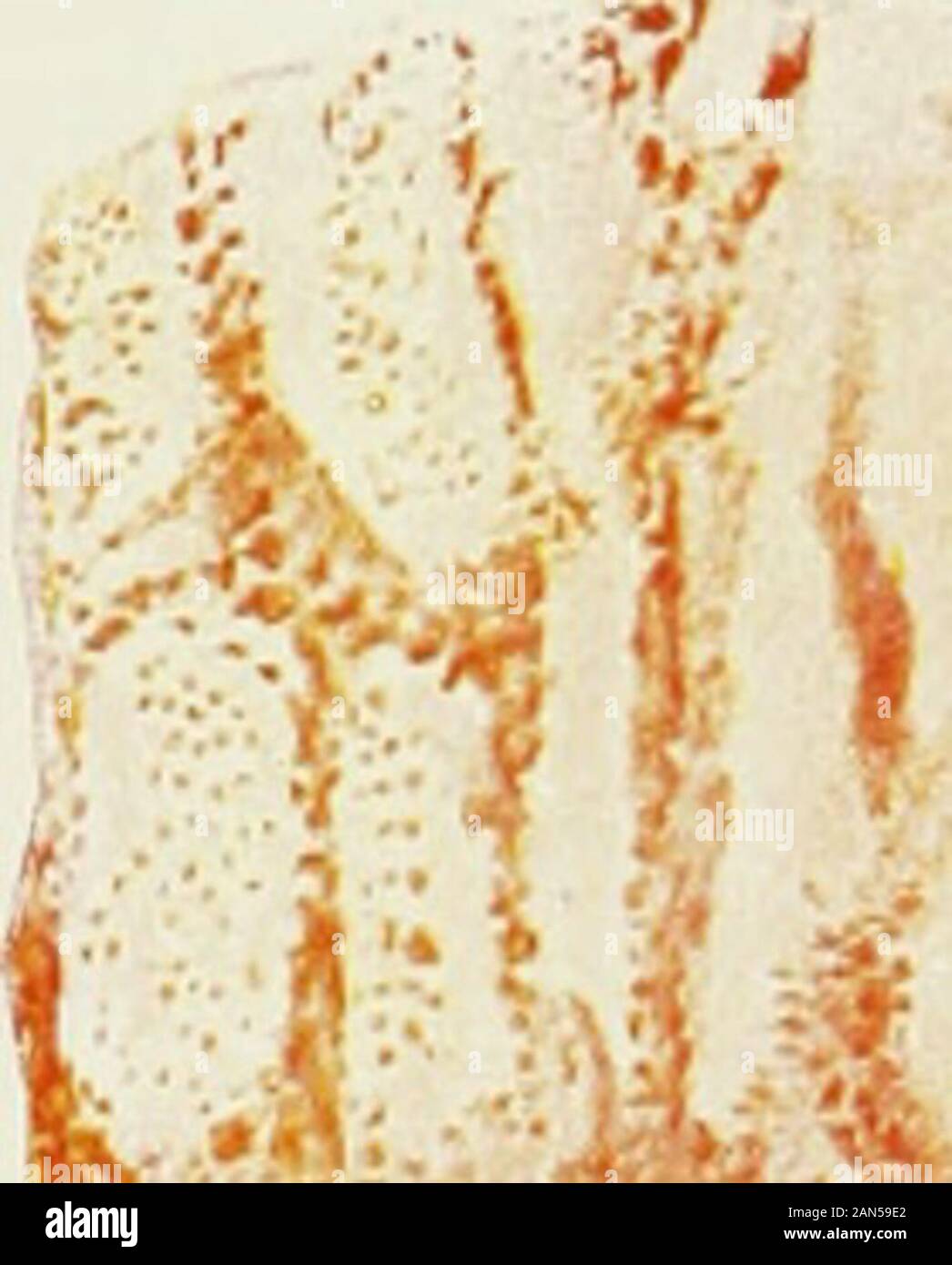 Die Klinik der Tuberkulose : Handbuch der gesamten Tuberkulose für Ärzte und Studierende . f r f Schnitt aus einer phthisischen Lunge, das Vordringen der Tuberkelbazillen in die Alveolen zeigend. Fig. 2.. , Vi I Stock Photo
