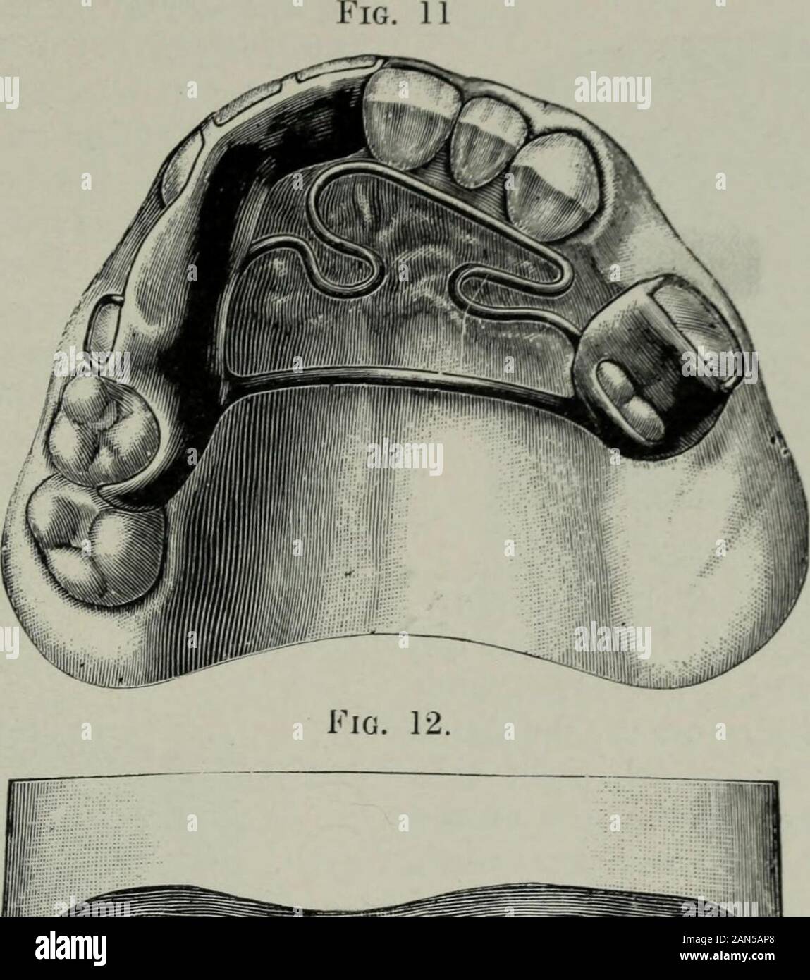 The Dental cosmos . od anchoragefor the correction of the irregular teeth.A device was arranged to open the bite, inorder to thus facilitate the movementof the irregularly placed teeth, and at thesame time to secure additional anchorageby making possible the attachment of theappliance to the upper incisors and ca-nine on the opposite side of the arch.A spring-clasp attachment was arrangedover the upper left first molar, the onlyremaining anchorage tooth on that side,and a spring-clasp attachment over the JACKSON.—ORTHODONTIA. 349 upper right second bicuspid—the firstbicuspid having been remove Stock Photo