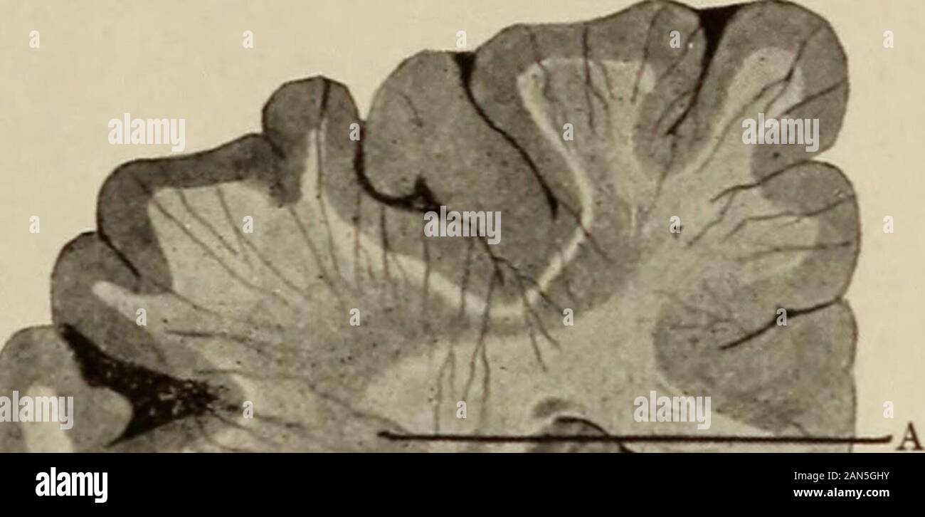 Nervous and mental diseases . Fig. 82.—Showing the distribution of the anterior, middle, and posterior cerebral arteries on thesurface of the brain. The numerals I, II, III, IV indicate the areas supplied by the different branches;the dotted lines indicate the main trunks (modified from Merkel and Debierre). almost come into anastomotic contact with the upward-reaching termina-tions of the capsular and ganglionic branches arising close to the circle.Between these arterial territories there remains an ill-nourished zonethat is prone to senile softening (Fig. 83). The cerebellum receives its blo Stock Photo