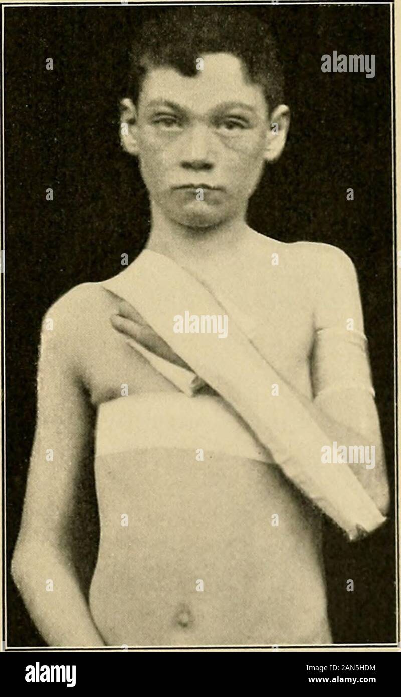 The treatment of fractures . Fie:. 126.—Fracture of the left clavi-cle. First adhesive-plaster strap applied.Second adhesive-plaster strap being ap-plied. Hole in plaster for olecranon visible.Note pad for wrist and folded towel pro-tecting skin of arm and chest. Fig. 127.—Fracture of the left clavicle.First and second adhesive-plaster strapsapplied. Pad in left hand. Shoulderpulled backward and elevated. 112 FRACTURES OF THE CLAVICLE within three weeks. At the time of union or shortly after thepatient may be allowed up with a simple retentive dressing, asling, and a swathe. The bed treatment Stock Photo