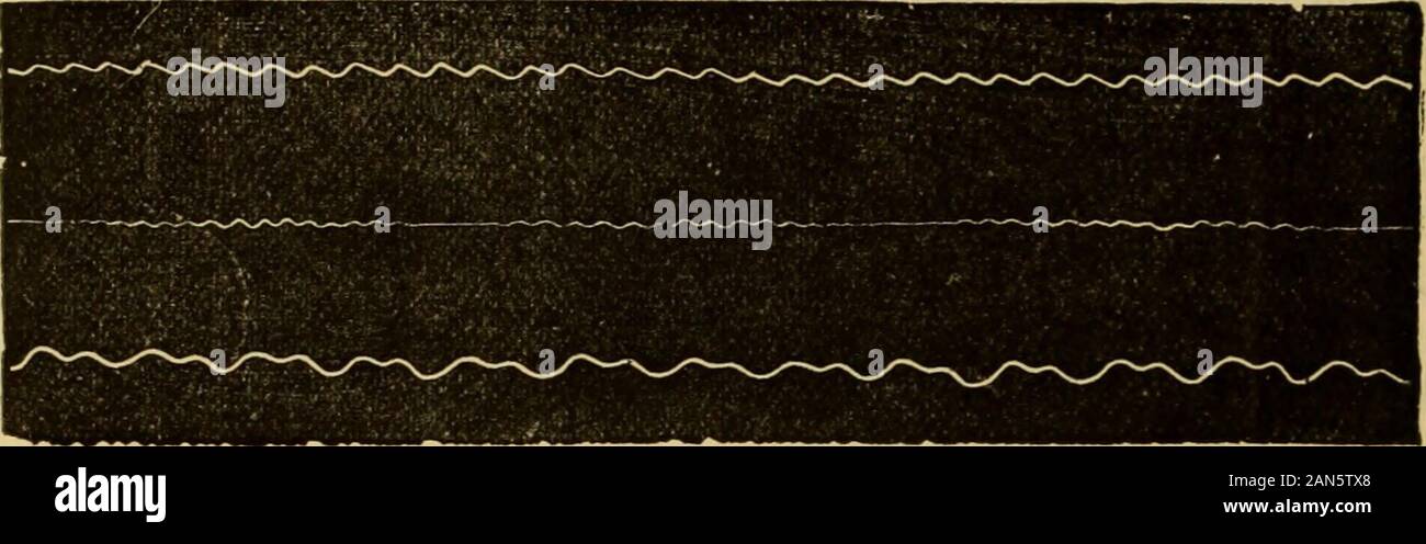 A text-book of the diseases of the ear and adjacent organs . (Fig. GO, 1) ; with com-pound notes, however, vibrations were created by the interference of thewaves of sound, which were visible upon the surface of the cylinder as regu-larly recurring straight-lined places between the spiral lines (Fig. 60, 2).The most regular drawing of this interference was obtained by the notes oftwo organ-pipes, which were exactly an octave apart ; in each great spiralcurve of the deeper octave, the smaller curve of the higher octave wasinserted (Fig. 00, 3). The proportion of the vibration of the ossicula de Stock Photo