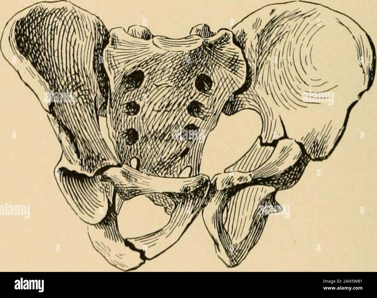 The treatment of fractures . • Sacro-iliac synchondrosis. pig, no.—Fracture  of rami of pubes; fracture and separation at sacro-iliac synchondrosis;much  displacement; bony union (Warren Museum).. l--j&lt;r. ,,, Fractured pelvis:  on the right,