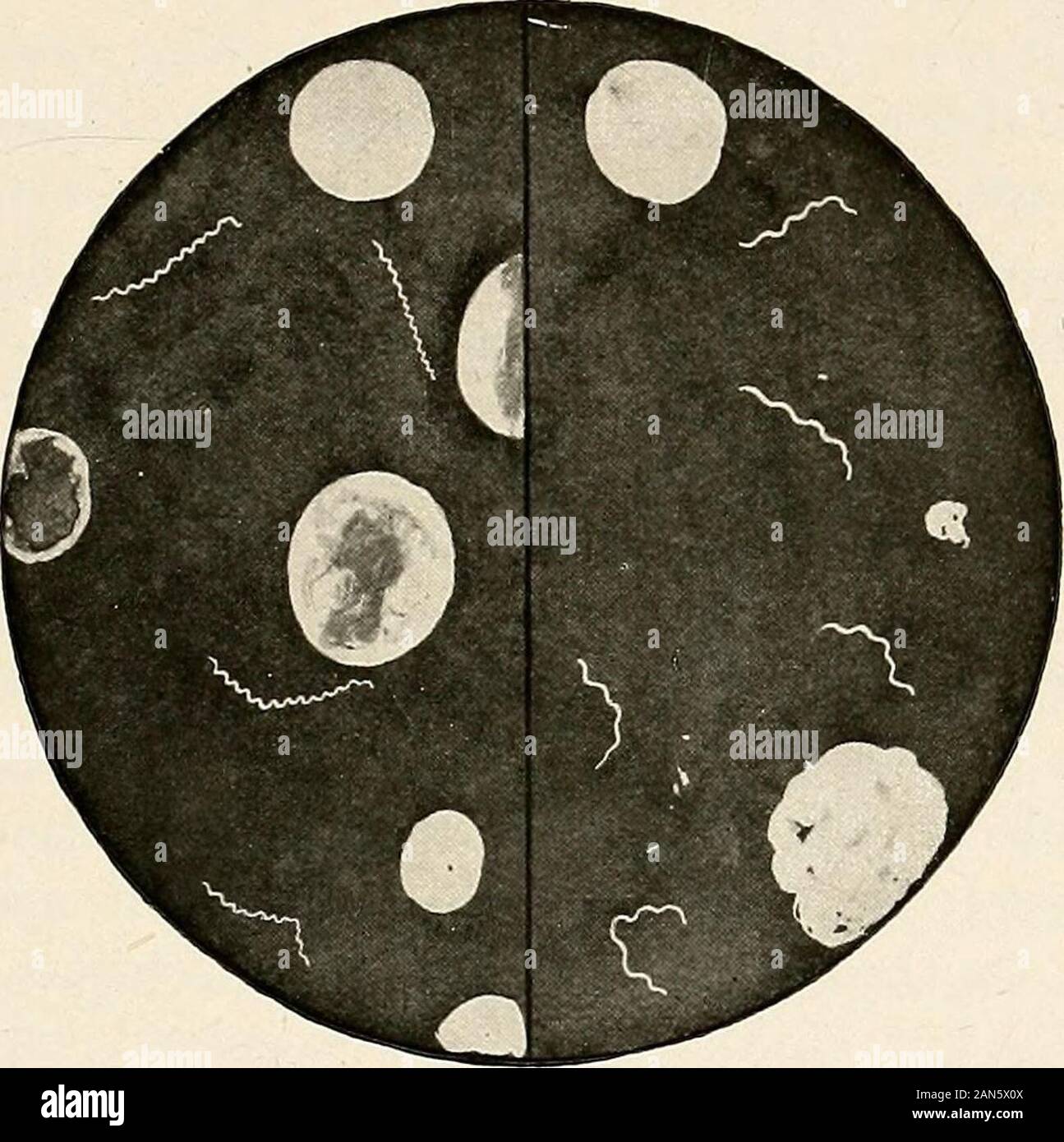 Gynaecology for students and practitioners . e probability oftuberculous peritonitis should always be borne in mind. Prognosis. The chronic miliary, or ascitic form gives the bestchance of recovery. The prognosis in the caseous form, with multiplebreaking-down foci, is unfavourable. The prognosis is better inadolescence than in young children and elderly subjects. Associatedphthisis or intestinal tuberculosis renders the prognosis grave. Hightemperature, blood and mucus in the stools, diarrhoea, frequent SYPHILIS IN WOMEN 317 vomiting, and emaciation are very unfavourable symptoms, as theyindi Stock Photo