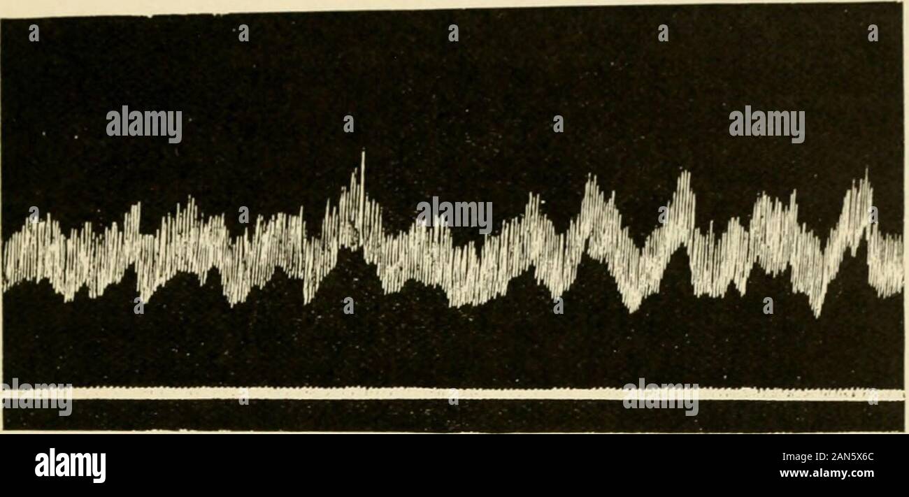 Physiology and biochemistry in modern medicine . ontractionswere very vigorous, the infant would show signs of restlessness andmight awake and cry. As in the adult, the contractions are evidentlyassociated with subjective sensations of hunger. Contractions of theempty stomach have also been recorded on a large variety of animals,including the dog, rabbit, cat, guinea pig, bird, frog and turtle. Theyvary somewhat in type in different animals. With regard to the time of onset of the tonus and hunger contractions,it has been observed that the only period during which the fundus isfree of them is Stock Photo