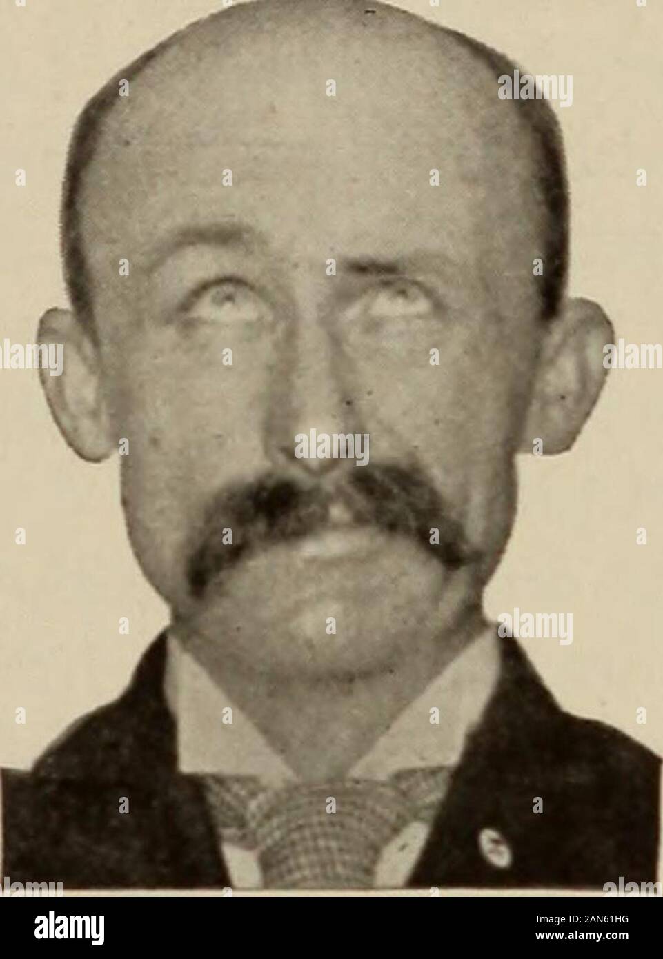 Nervous and mental diseases . 11 Mm^iiU iIm^I. Fig. 49.—Same case six months later. 9 shows late contracture on xhv paretic side while the faceis at rest; 10, contracture in the lower half of the face increased by gently closing the eyes, and at thesame time shows weakness about left eye; 11, contracture increased by raising brows, showing over-action of zygoniatici and weakness of frontalis on left side. As the face recovers, in every instance the paretic side is likelv tooveract for all moderate voluntary bilateral movements. It would seemthat the neuritis had left a certain nuclear irritabi Stock Photo