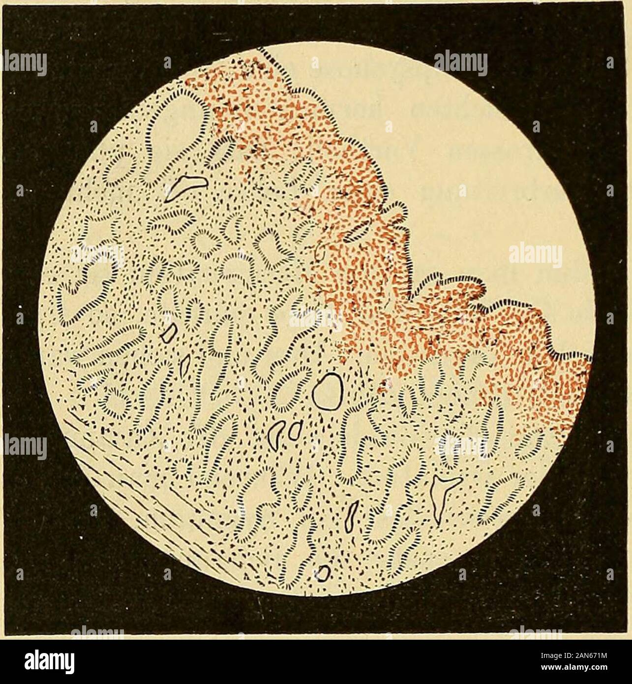 Die Krankheiten der Frauen : für Ärzte und Studierende . ion zusammengehören,dass aber sowohl Menstrua-tion ohne Ovulation alsOvulation ohne Menstrua-tion vorkommt. Ueber die Art und Weise,wie die Blutung zu Standekommt, herrschen folgende Ansichten. Die Uterusschleimhaut verändertsich fortwährend, es besteht eine Art Ebbe und Fluth. Beginnen wir miteintretender Menstruation, so ist hier die Schleimhaut gleichsam gereift.Eine bedeutende Congestion hat ihr viel Blut zugeführt, die Schleimhautist geschwollen, verdickt und hyperämisch. Die Drüsen erscheinen un-regelmässiger angeordnet, dicker, si Stock Photo