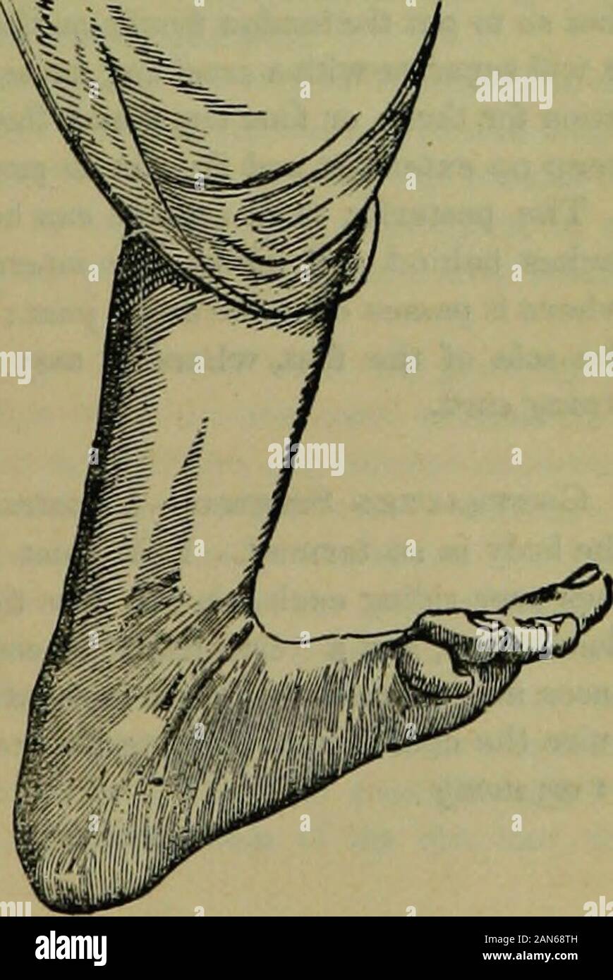 The hydropathic encyclopedia: a system of hydropathy and hygiene .. . TALIPES VARUS. TALIPES EQUINAS. inward, the patient walking on the outside of it, the heel being e*evated. In the second variety Fig. 215. —talipes equinas—fig. 214, theheel is more or less elevated, thepatient walking on the ball ofthe foot or on the toes, and pres-sing equally on all the toes, orprincipally on the side of the lit-tle, or that of the great toe. Inthe third—talipes valgus—thefoot is turned out so that thepatient walks on the inner sur-face, the external edge beingraised from the ground, and theBole standing Stock Photo