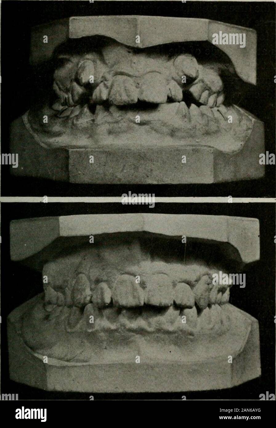 Maxillary first molar hi-res stock photography and images - Alamy