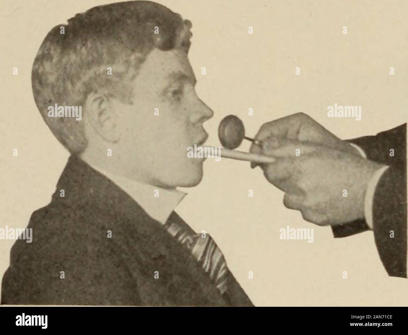 Jaw jerk reflex hires stock photography and images Alamy