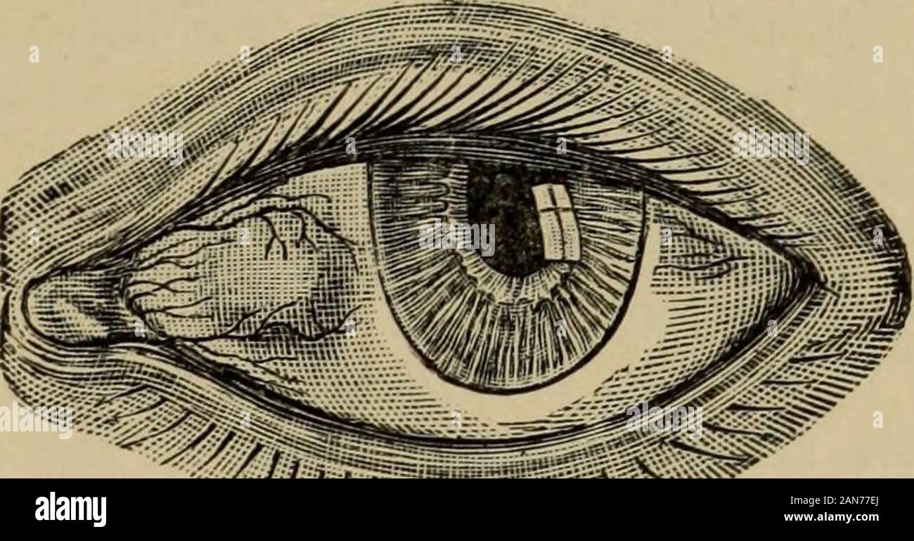 Text-book of ophthalmology . ich nevertheless allows the yellowcolor of the underlying fat to showthrough. skin with glands, since the amniotic bands are sim-ple connective tissue. It is henoe more probable that the amnion contributes to thedevelopment of dermoids only to this extent, that when there is a smaller amount ofamniotic fluid, the amnion is in closer contact with the eye and may press the lid againstthe surface of the eyeball. The same thing might be done by amniotic bands. As aresult of the pressure there might develop a circumscribed adhesion between the lidand the eyeball, which Stock Photo
