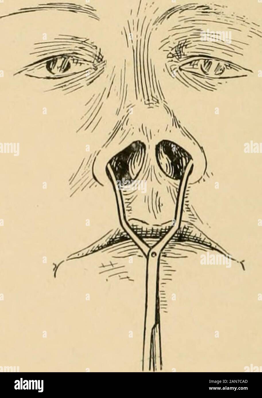 Bone hematoma hi-res stock photography and images - Alamy