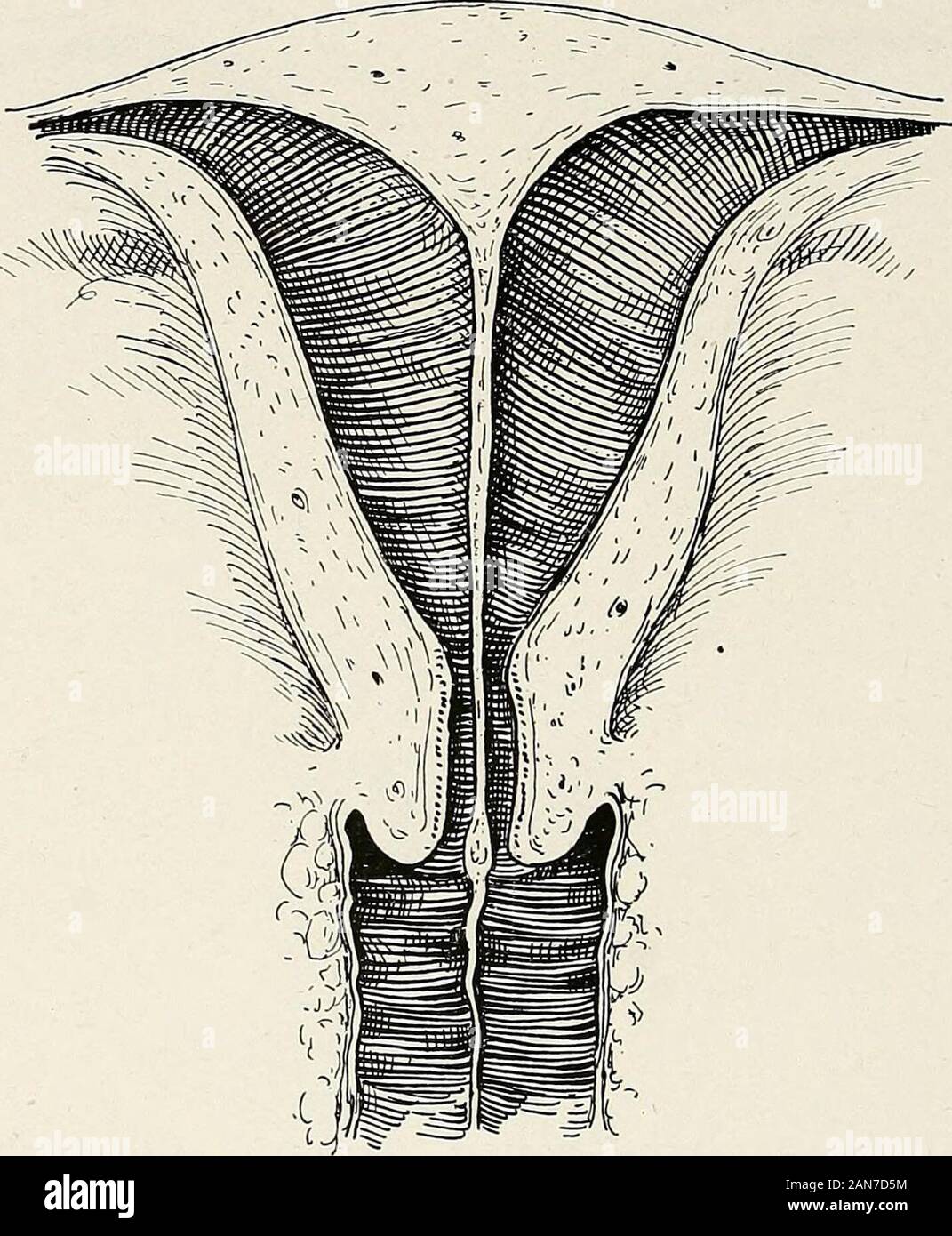 Gynaecology for students and practitioners . pian tube itself on the side of the imperfection may be well developed;but the undeveloped horn rarely communicates with the uterinecavity. Such an imperfectly developed horn may become the seatof an ectopic pregnancy, the spermatozoa reaching it by migrationfrom the opposite tube across the pouch of Douglas (external wander-ing). The mucous membrane of an undeveloped horn penetratesdeeply into the muscular stroma {see Fig. 91). 160 GYNECOLOGY These six recognized types of double uterus are clearly producedby arrest at some stage or other of the nor Stock Photo