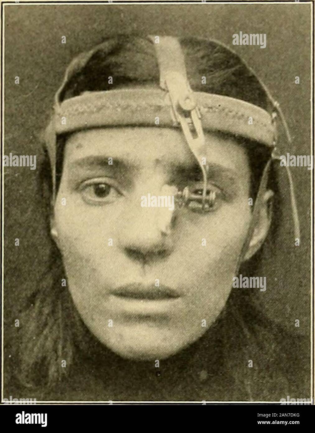 The treatment of fractures . Fig. 11. — Fracture inasal bones. Tin nose-splint applied. THE NASAL SEPTUM IN FRACTLKl. ()l UK NOSE 51 well to remember in this connection that suppurating wounds dofar better if dressed frequently than if left to accumulate purulentdischarges. After a blow upon the nose, even if there is no immediate de-formity, the nose should be examined to determine the presenceof swelling- upon the cartilaginous septum. Even a slight blowupon the nose may cause a hematoma of the cartilaginous septum(see Fig. 44). This hematoma is liable to become infected andto suppurate. Con Stock Photo