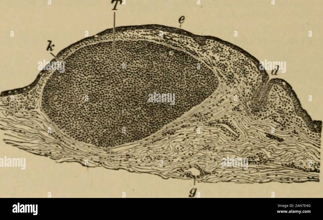 Text-book of ophthalmology . Fig. 50.—Granulation from the Retrotarsal Fold of a Monkey. Magnified 52 X 1.The monkey. 32 days, before had received inoculation from a case of ophthalmia neonatorum,the secretion of which contained no gonococci but did contain the inclusions which are like those occurringin trachoma and are [the mark of inclusion-cell conjunctivitis, see pages 161 and 180]. The granula-tion shows the same histological picture as a trachoma granulation in man. Itis still recent and henceisnot yet shut off by a capsule from its surroundings. The central lighter portion, which in th Stock Photo