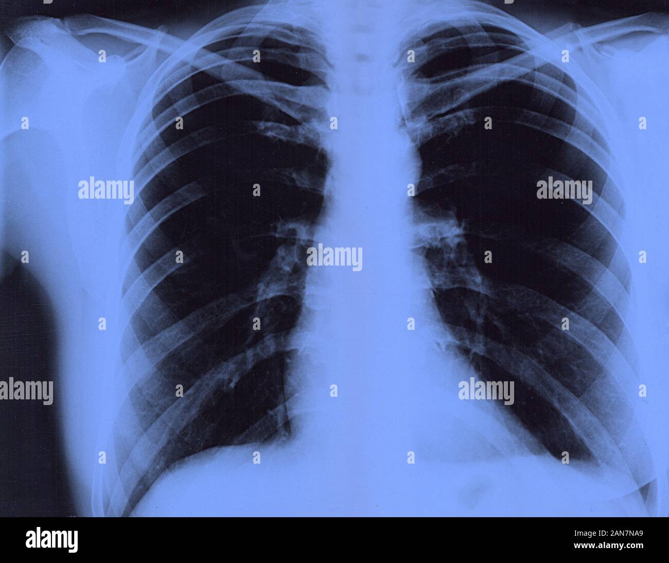 Xray of the lungs of a healthy person. Female chest xray film. Close