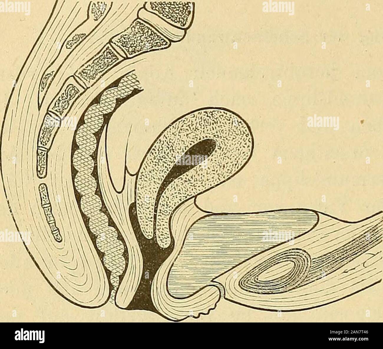 Die Krankheiten der Frauen : für Ärzte und Studierende . rderen Vaginalwand undeine geringe Cystocele zurück. Nicht unwichtig ist auch die Muskulatur des Beckenbodens. Wenndas Kind „durchtritt^^, wird der Levator ani gewaltsam gedehnt undan die Beckenwand angedrückt. Bleibt der Levator schlaff, so bleibtzwischen beiden Hälften der Raum weit. Die Scheide entbehrt derStütze und der Uterus kann vorfallen. Auch der Dammriss hat ätiologische Wichtigkeit. Ist die Scheidehinten durchtrennt, so schiebt sich die Scheidenwandung nach vorn zu-sammen. Dann ist vorn gleichsam zu viel Material, die vordere Stock Photo