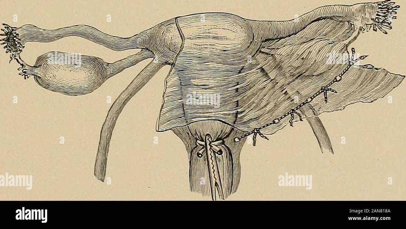 The rules of aseptic and antiseptic surgery; a practical treatise for the use of students and the general practitioner . ms aslender pedicle to theotherwise movablewomb), the applica-tion of double liga-tures can be obviatedby cutting off the blood-supply of the organ from all sides by two continuous lines of massligatures converging from the free margin of the adnexa toward the cervix.A suitable-sized mass is first formed at the margin of the broad ligament bymeans of Thierschs spindle, and is tied off with strong catgut or silk. Asecond mass adjoining the first one is now isolated, and the t Stock Photo