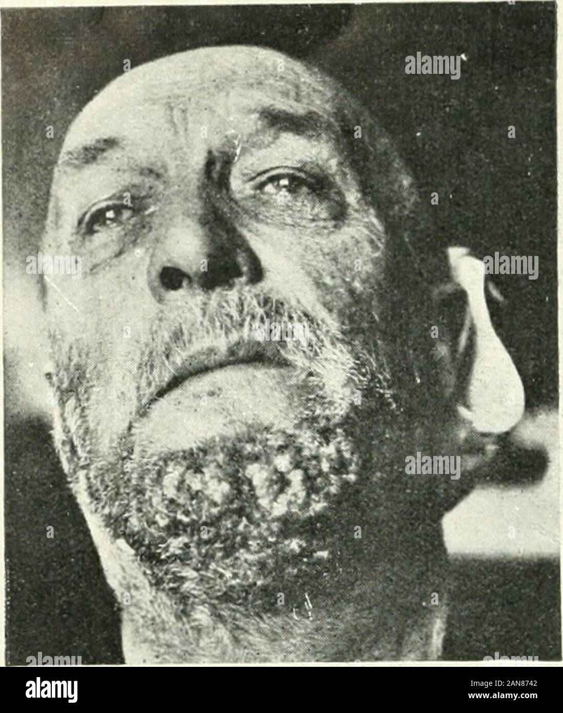 The British journal of dermatology . Fici. 1.—Patient on admission tothe Clinic.. Fio. 2.—Recent eiui^tion of erytlieuiatous nodes on thefoieavm. Stock Photo