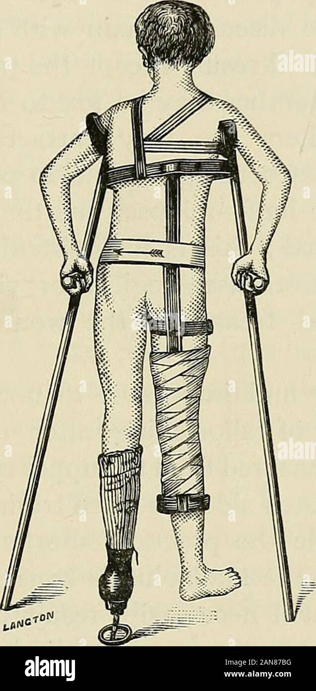 Hip disease in childhood : with special reference to its treatment by excision . econdly, after excision, to keep the limb quiet fora time until the parts are sufficiently consolidated to allowof movement being begun. I have habitually used it forseveral years. There is always, as the parts cicatrise, a tendency toflexion and adduction of the affected limb after excision,and this must be avoided or a comparatively useless legwill result. As soon as the limb gets firm, it is a goodplan to get the patient up and let him support himselfand walk a little with crutches and a patten on thefsoundlimb Stock Photo