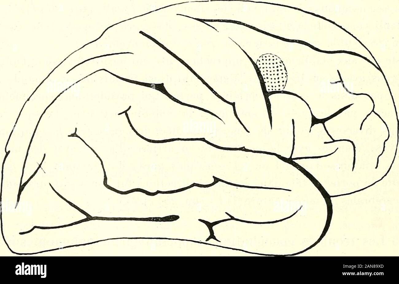 Traité des torticolis spasmodiques, spasmes, tics, rythmies du cou, torticolis mental, etc. . FiG. U2. — Centre uccipito-pariétal des mouvriucuts de la télc et des yeux, obtenu parsuperposition des piriiicipaux schémas expérimentaux ou cliniques reproduits dansle mémoire de Grasset (publié en 187il, dans le Montpellier médical).. FiG. 63. — Centre des mouvements de rotation de la tète i^t des yeux, (fig. 4 de Lamacq).Il sagit presque toujours, dans ce cas, de mouvemints portant à la fois sur la tèteet les yeux. térieure de la deuxième frontale (fig. 63 et 64); cest ce qui sestproduit dans un c Stock Photo