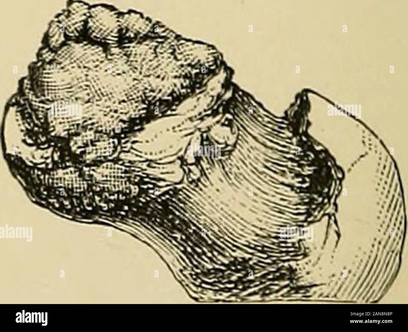 Hip disease in childhood : with special reference to its treatment by excision . The section shows osteomyelitis of the wholeepiphysis, and thinning and loosening of thearticular cartilage by subchondral caries.The trochanter is seen on the left of thefigure. Alfred D., case 1.. Surfact view. A mass of granulations is seencovering the carious remains of the epi-physis. Portions of the marginal cartilageare still left. William M., case 36. Ace-tabulum necrosed and perforated. HIP DISEASE IN CHILDHOOD, WITH SPECIAL REFERENCE TO ITS TREATMENT BY EXCISION. BY G. A. WRIGHT, B.A., M.B. Oxon., F.R.C. Stock Photo