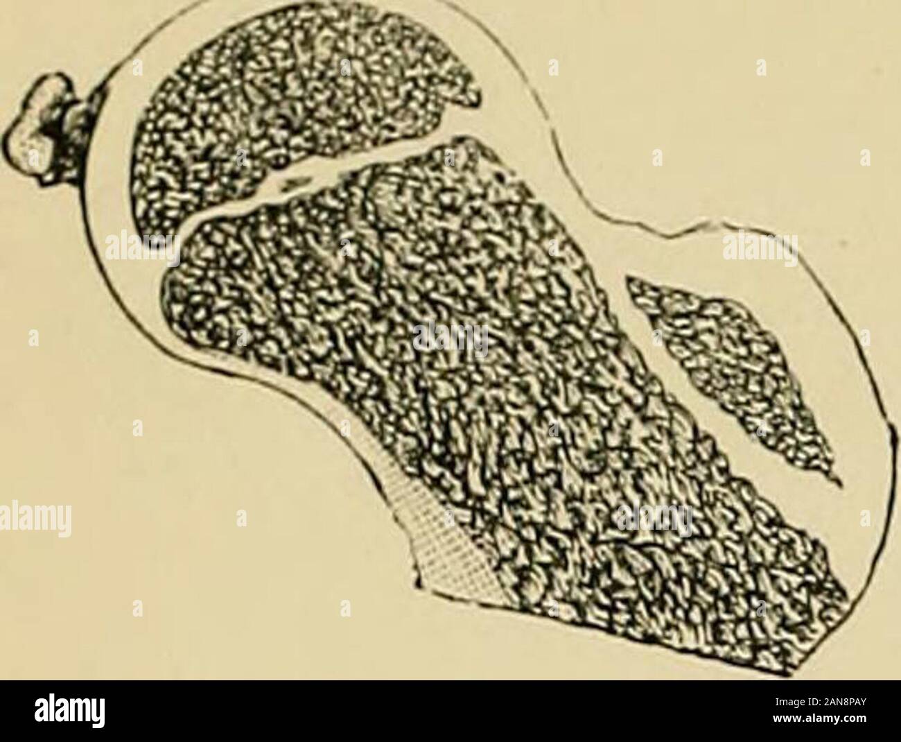 Hip disease in childhood : with special reference to its treatment by excision . bercle and scrofula, 24Tubercular meningitis, 127, 192, 224, 225, 226Tuberculosis, 9, 23, 27 acute, 34 Tumour, 72 Two foci of disease, 181, 1S6, 188,189, 194 Types of disease, 27 Ulceration of cartilage, 13, 20synovial membrane, 72 Vaginitis, 3Various cases, 223 Walking, 117Wasting, 51Weight, 88Wood-wool, 108 Y epiphysis, 6, 22 Zinc chloride, 103 A. IRELAND AND CO., lRINTEKS, IALL HALL, MANCHESTER. /-lATTTTlfTlTA TTXTTT7T7CiTrrUE RD682Wright W93 RDC06L8U2BW93VcT UBRARES (hSl,stx) Hip disease in childhood : 2002279 Stock Photo