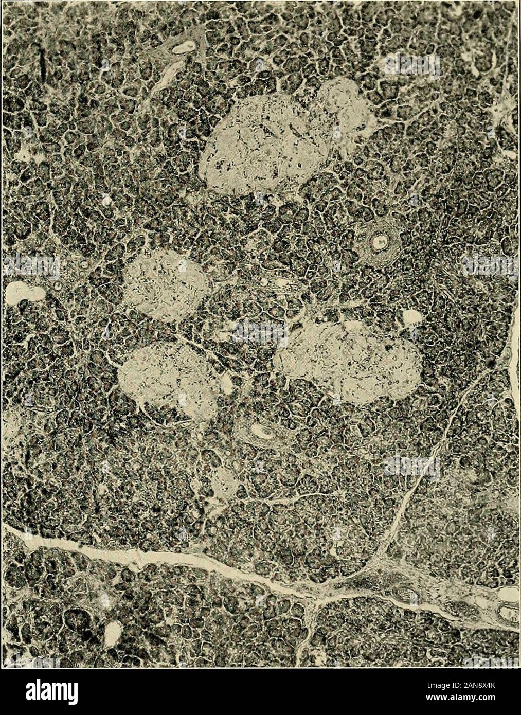 Medical And Surgical Report Of The Presbyterian Hospital In The City Of New York Estruction Of Parenchyma Opie Believes That The Simple Or Granular Atrophy Of Thepancreas Which Certain Writers Including