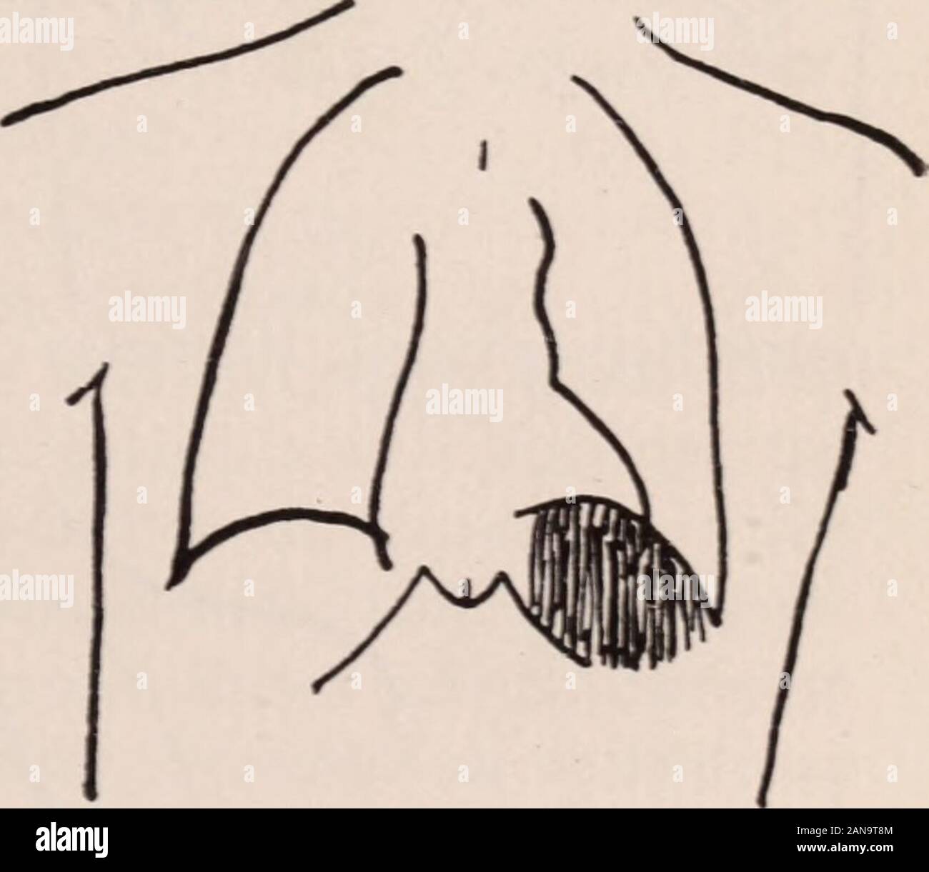 Albany medical annals . Left Diaphragm Elevated;Diaphragmatic Hernia