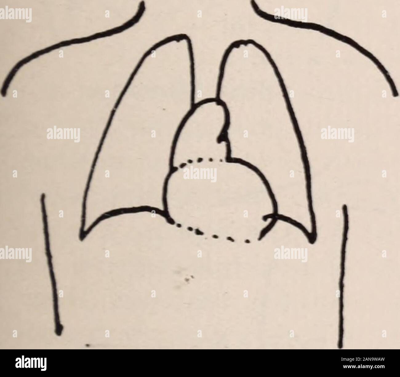 Albany medical annals . Left Diaphragm Elevated;Diaphragmatic Hernia