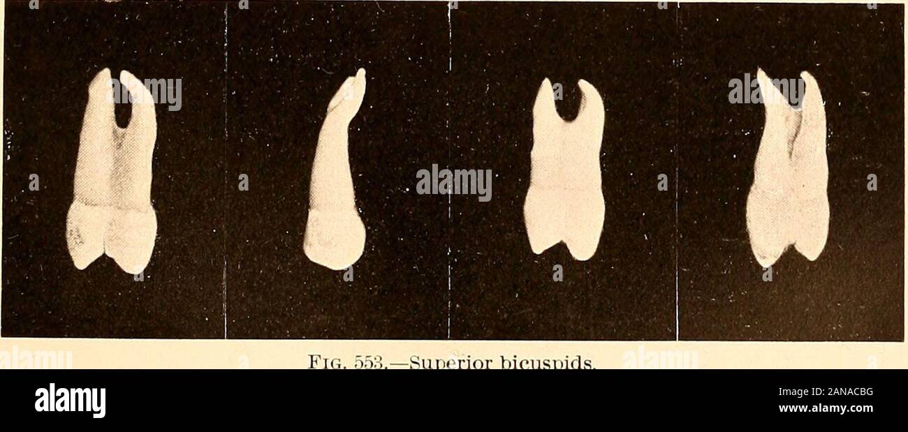 Principles and practice of operative dentistry . A, doublerooted superior lateral incisor; B