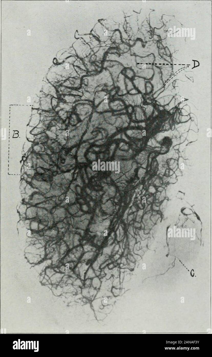 The Journal of laboratory and clinical medicine . presenting both a normal and an abnormalspecimen for differential study. To illustrate the results of this method, photographs of two plates are pre-sented (Figs 2 and 3). There was a clinical diagnosis of cerebral hemorrhage. The autopsy diag-nosis made without sectioning the brain was arteriosclerosis; dififuse subarach-noid hemorrhage from the right and left posterior cerebellar arteries; throm- Radiographic Studies of Cerebral Vascular Lesions 839 bosis of the right and left posterior cerebellar arteries. After the exposure tothe x-ray the Stock Photo