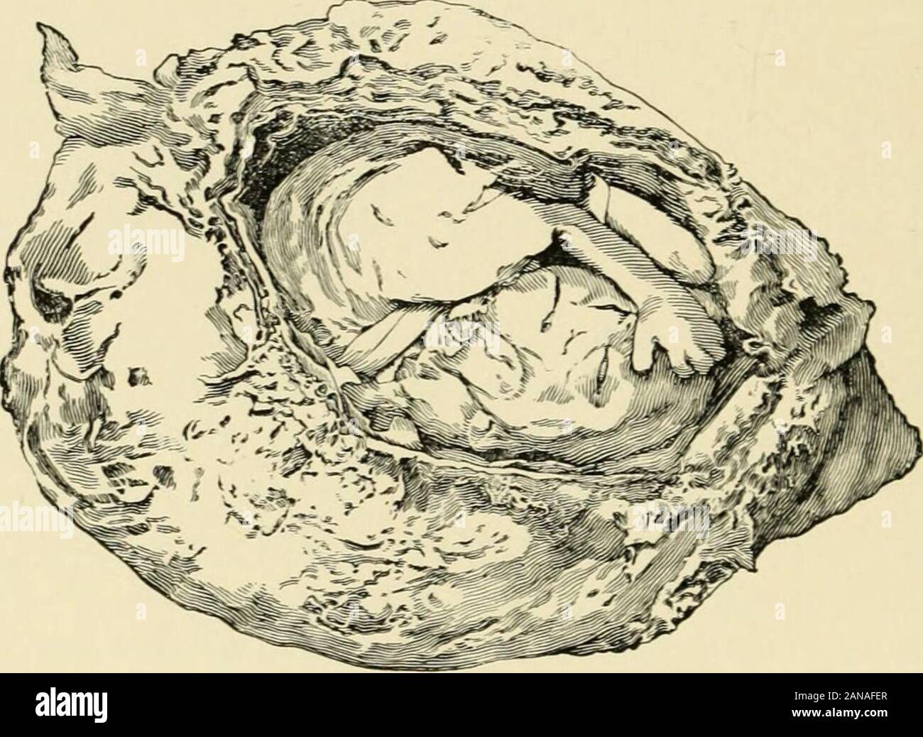 A textbook of obstetrics . Beitrage zurPathologie des Eies, Monats. f. Geburtsh., Bd. xxxi, S. 34. 5 Tarnier et Budin, op. a/., p. 474. 6 Pathology of Intra-uterine Death, London, 1887, p. 8. 248 PREGNANCY. Clinical Phenomena of Abortion.—The main clinical phe-nomena of abortion are: (1) Hemorrhage, (2) pain, and (3) theexpulsion of more or less characteristic portions of an impreg-nated ovum. But these symptoms are rarely all manifested in atypical manner in every case. Pain may be absent, hemorrhagenot excessive, and the whole ovum when cast off so small that itescapes unnoticed among the cl Stock Photo