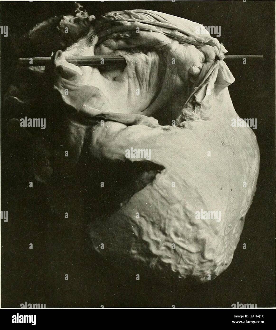 Studies in cardiac pathology . l waterloggedfrom back-pressure in the right heart. Emboli from the rightheart may reach the general circulation by passing through apatulous foramen ovale or interventricular septum or ductusarteriosus. ABNORMAL FIBROUS BANDS The so-called abnormal fibrous bands of the heart are chieflyfound in the ventricles. According to Tawara, they representa congenital anomaly of the auriculo-ventricular bundle; anopinion based solely on their course and distribution. Roessle^showed that these fibrous bands contained muscular tissue, butregarded their structure as the resul Stock Photo