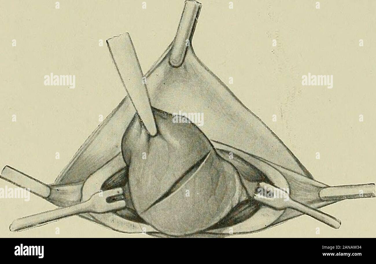Chirurgie der Thymusdrüse . Fig. 63. Die tiefe Halsfaszie ist in der Längsrichtung gespalten, mit den Muskeln auseinander-gehalten. Das Spatiura praetracheale liegt vor, in welches die Thymusdrüse hinaufragt.. Fig. 64. Die Thymuskapsel ist mit dem Pean gefaßt, vorgezogen und in der Querrichtun^ inzidiert. Stock Photo