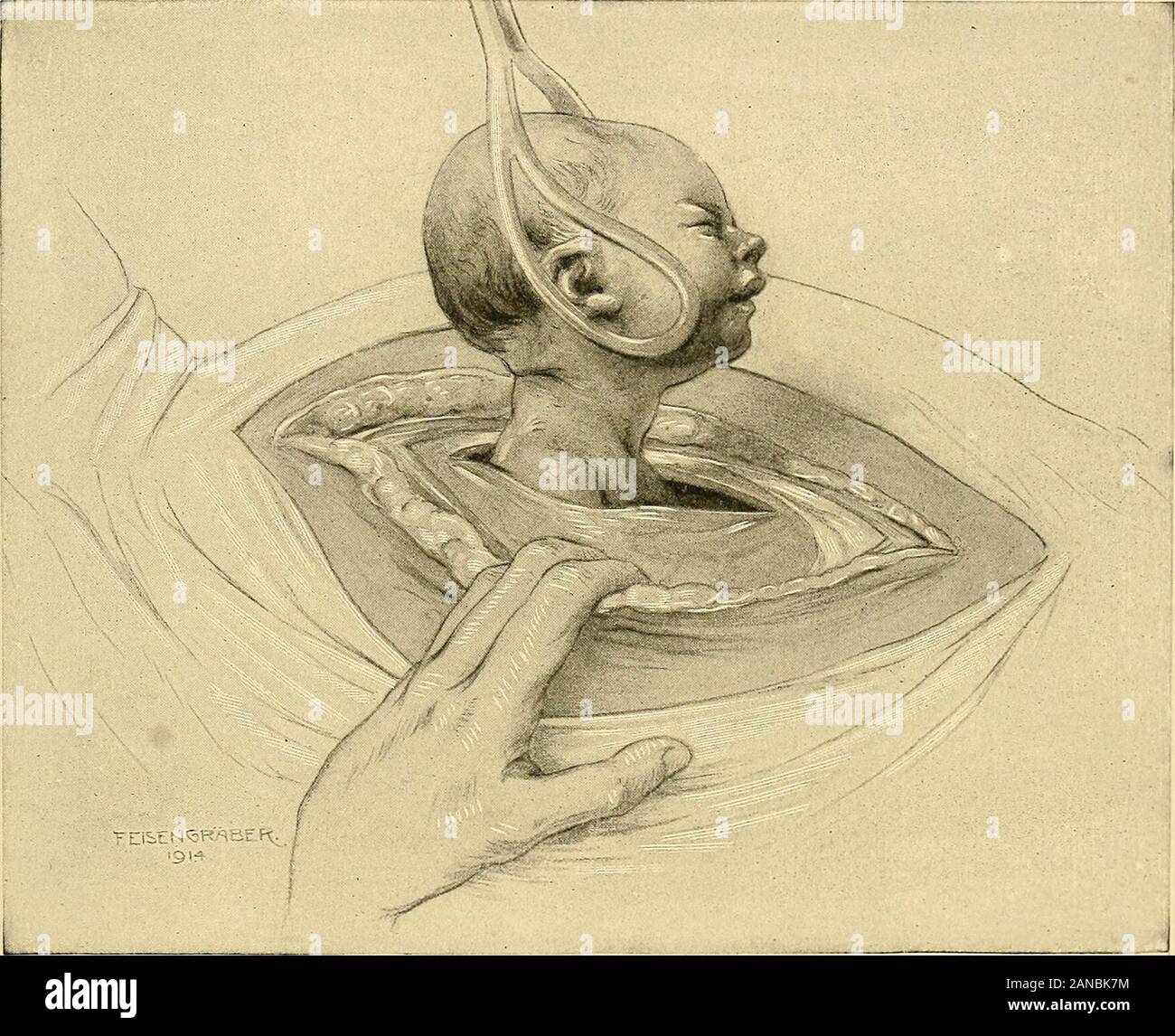 Cesarean section . cs, copyright by W. B. Saunders.) The abdomen is
