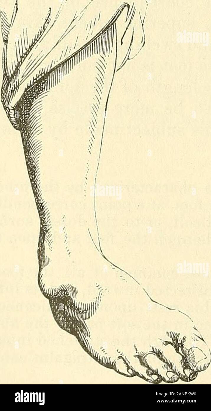 A practical treatise on fractures and dislocations . e clinical history of the dislocations by rotation or by renversement is tooincomplete yet to give any hope of their diagnosis being established with pre-cision. I will relate, however, in the way of information, what has been writtenby M. Delorme regarding the signs which, according to his statement, wouldenable one to diagnosticate the dislocations of the astragalus by renversementor upside down. If, in the dislocation without rotation, the two bony borders of the pulley ofthe astragalus be looked for, they begin to be felt very near the h Stock Photo