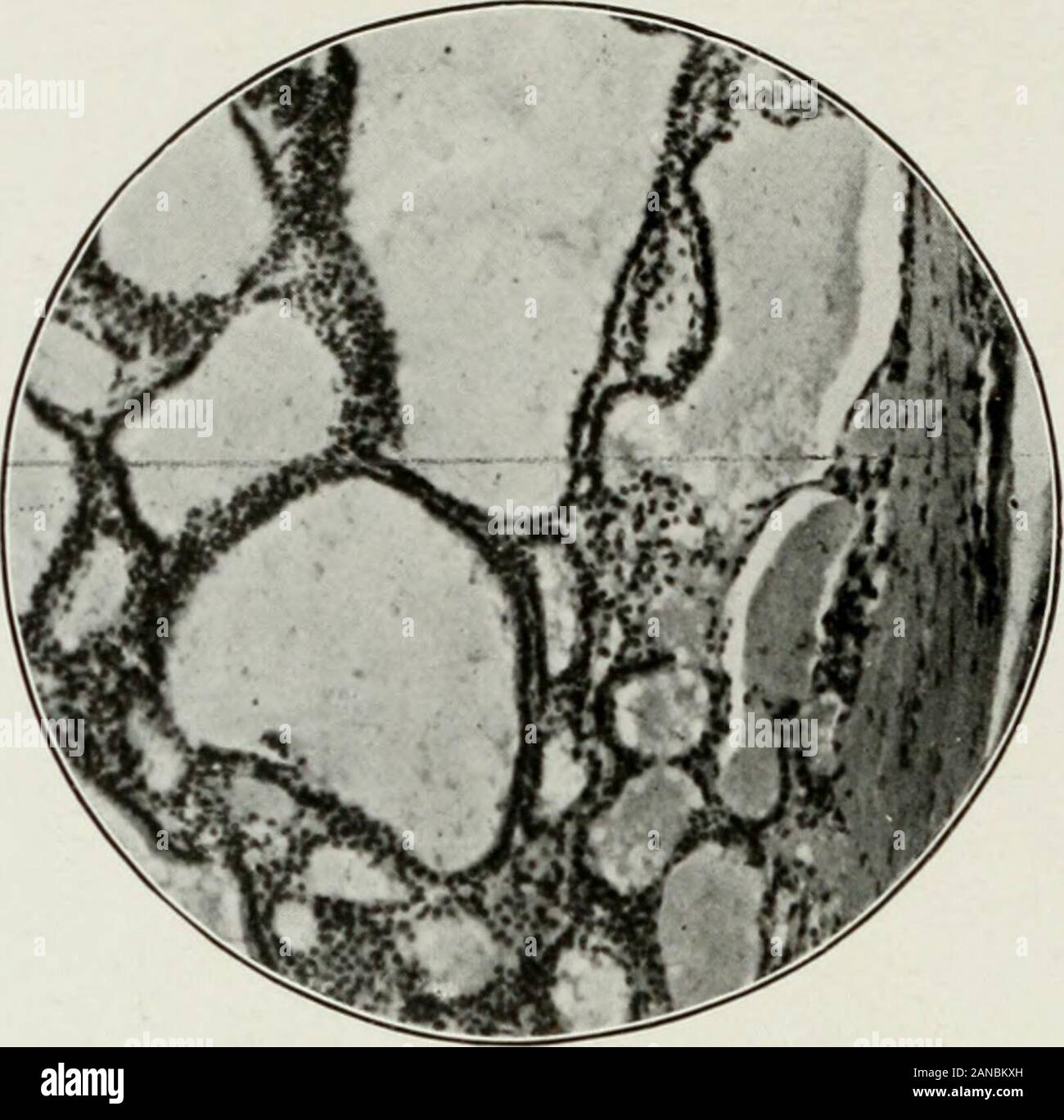 Archives of internal medicine . Fig. 1(T.—Premature atrophy (cretinoid) of childhood. Note the generalizedincrease in the stroma; the compressed follicles; the desquamation and perhapspiling up of the epithelial elements; the absence of colloid. the normal human thyroid. All the follicles are tilled with clear, aml)eryellow, viscid colloid, which gives to the thyroid its specific characteristic.The microscopical appearance of the thyroid unit—the alveolus orfollicle—is similar in all animals from fish to man. The follicles are ingeneral round or oval, closed spaces lined with a single layer of Stock Photo