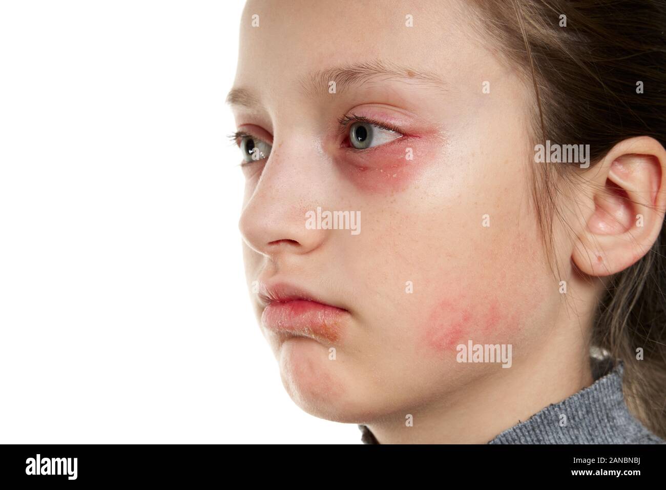 mild allergic reaction on face