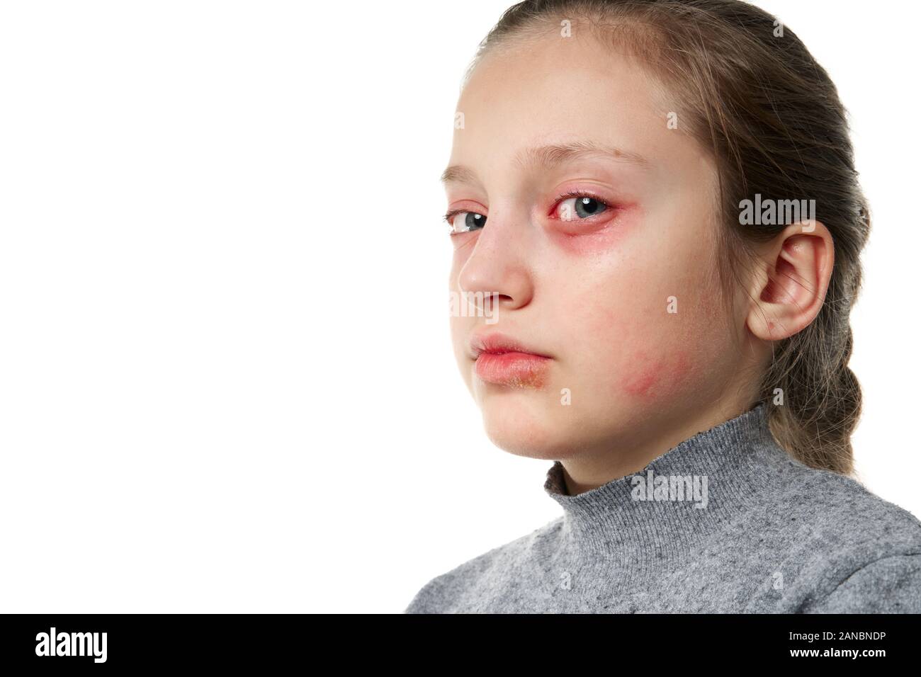 Allergic reaction, skin rash, close view portrait of a girl's face. Redness and inflammation of