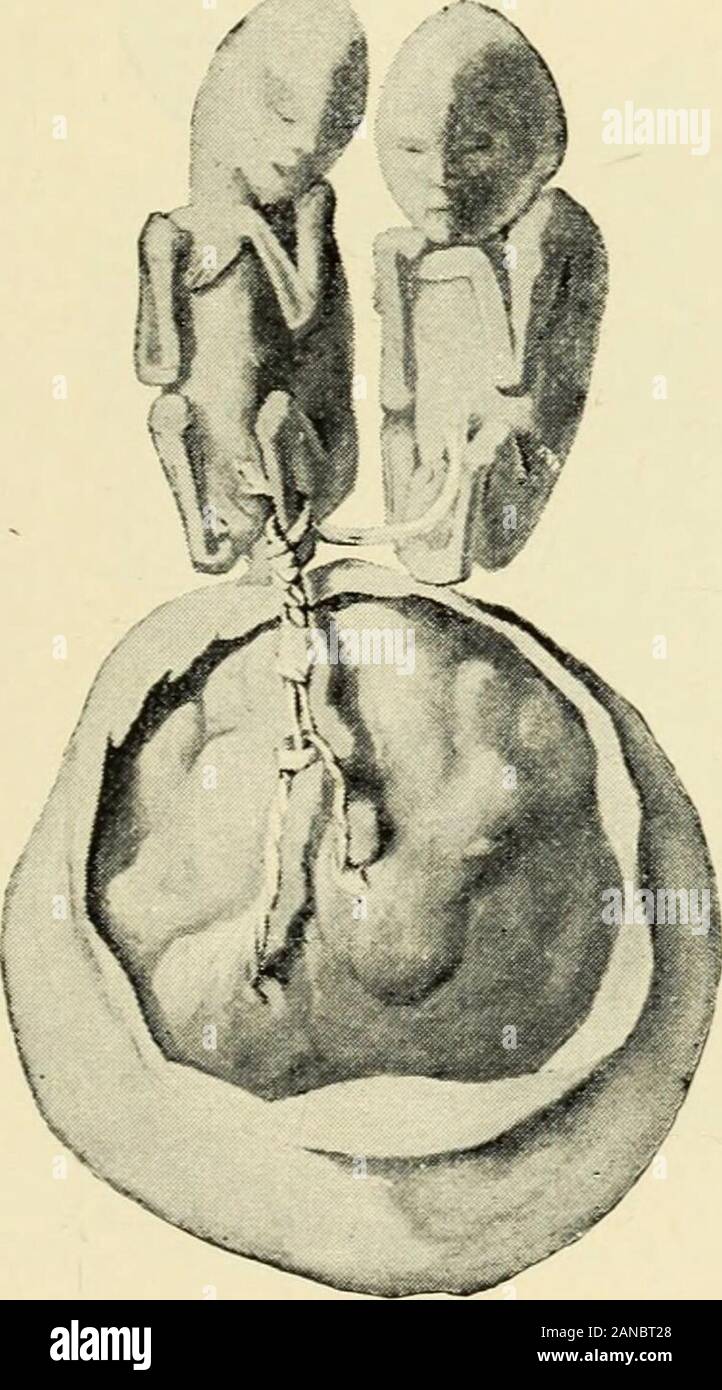 Marginal umbilical cord insertion hi-res stock photography and images ...
