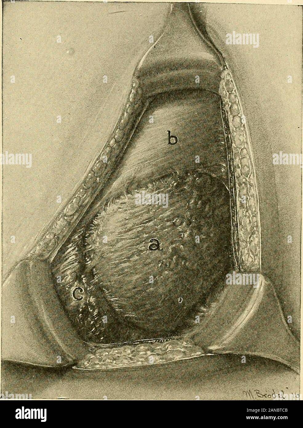 Cesarean skin to skin hires stock photography and images Alamy